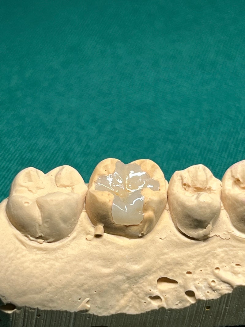 E-max inlay :) : 네이버 블로그
