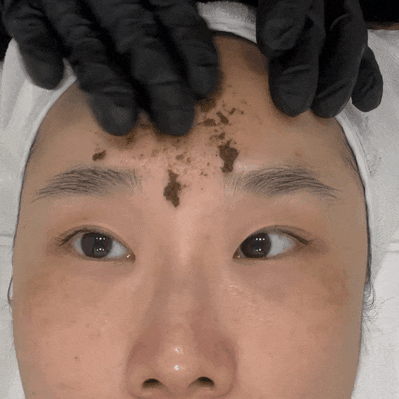  왕십리피부관리 디유에스테틱왕십리점 진피재생필 꿀광 피부 만들기