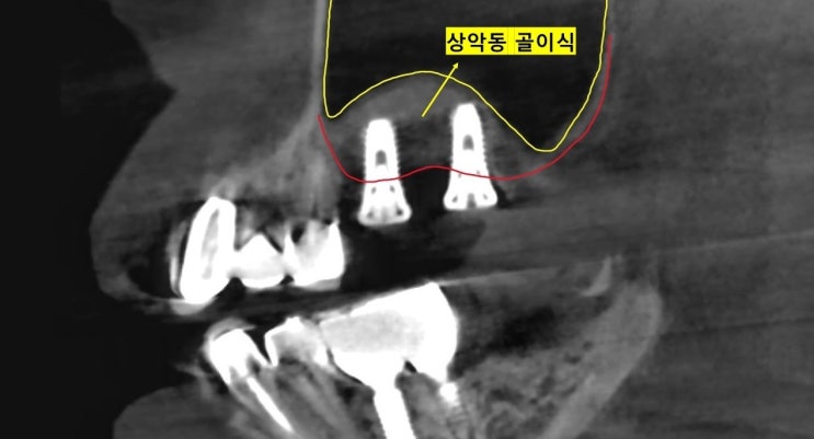  상악동 거상술(측방 접근법, 상악동 임플란트) feat. 임플란트 수술이 어려운 분들을 위한 방법