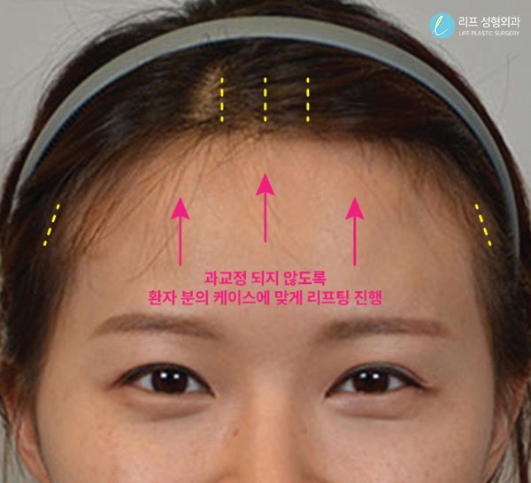 이마거상술후기 6년 넘은 7