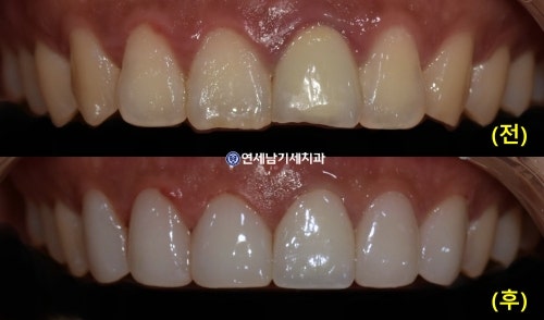 앞니부분교정 비용? 치아 다듬기10분 4