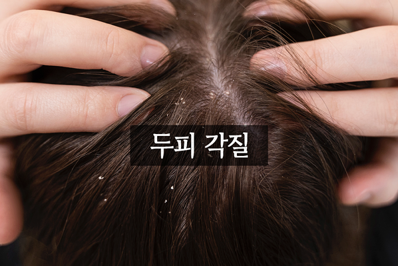 두피 관리, 각질 원인 및 제거 방법 : 네이버 블로그