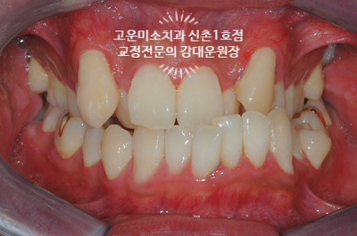  비대칭 덧니 주걱턱 복합된 부정교합치료 증례 고운미소치과신촌1호점