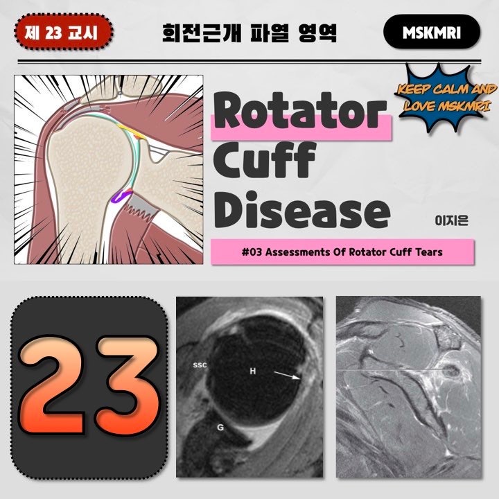  [Rotator cuff Tear 23] #03 Assessments of Rotator Cuff Tears