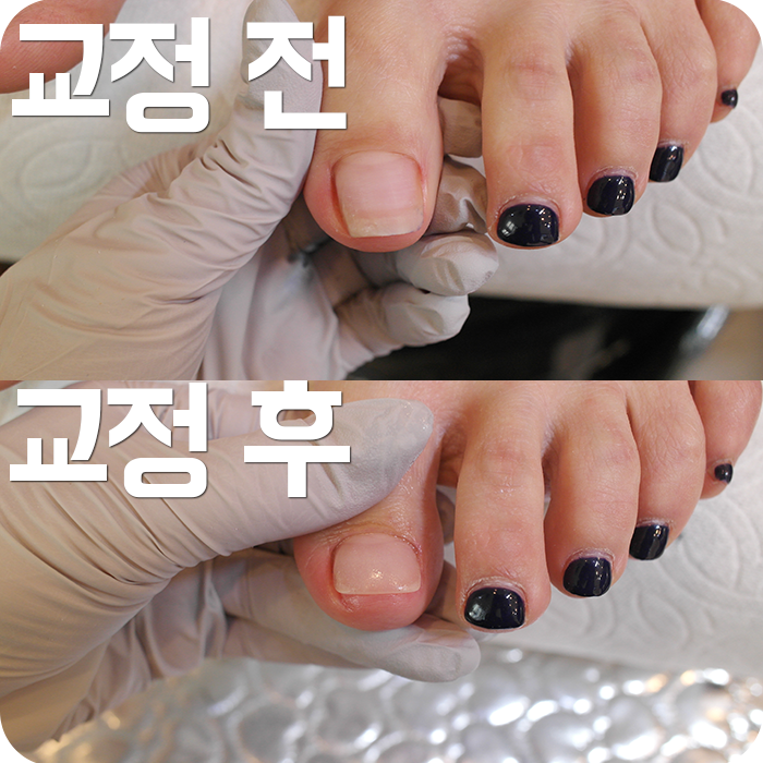 스트레스 해소를 위한 대구 자란 발톱 스트레스 해소를 위한 대구 자란 발톱