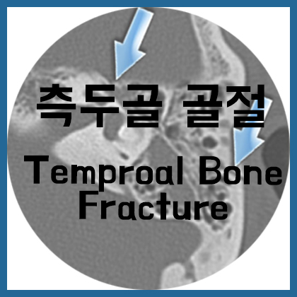  [귀] 측두골 골절(Temporal Bone fracture)