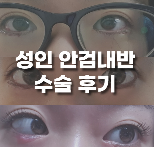  성인 안검내반 수술 후기, 드림안과의원