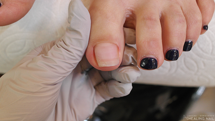 스트레스 해소를 위한 대구 자란 발톱 2