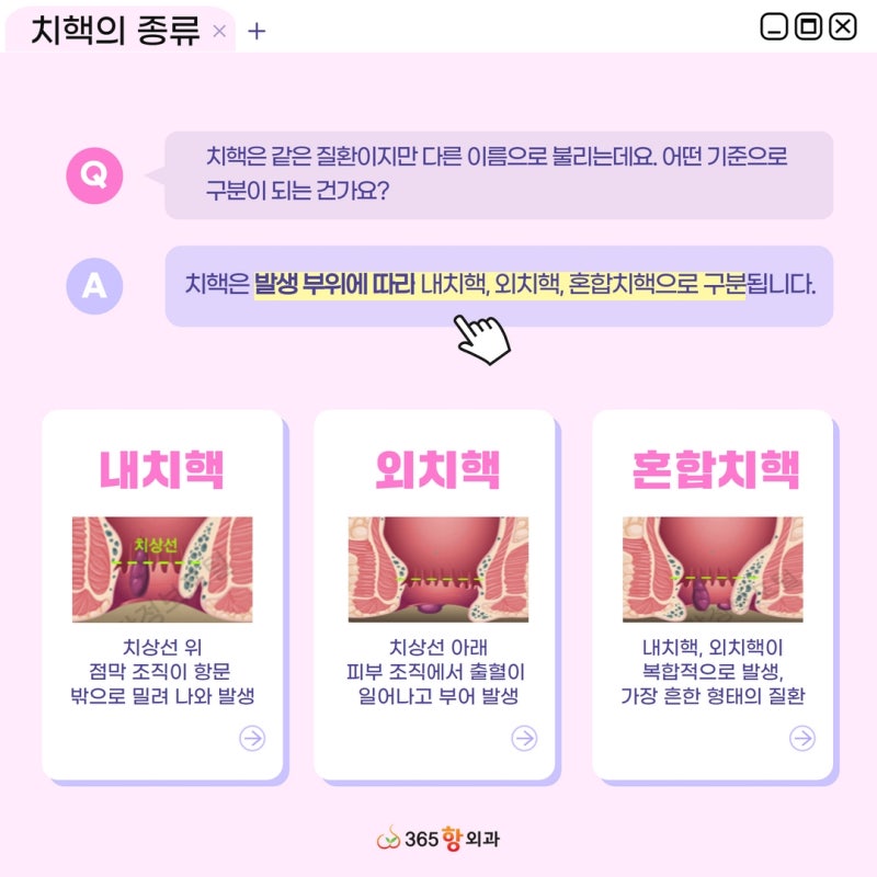 서울숙 항문외과, 외치핵과 내치핵의 차이점은?