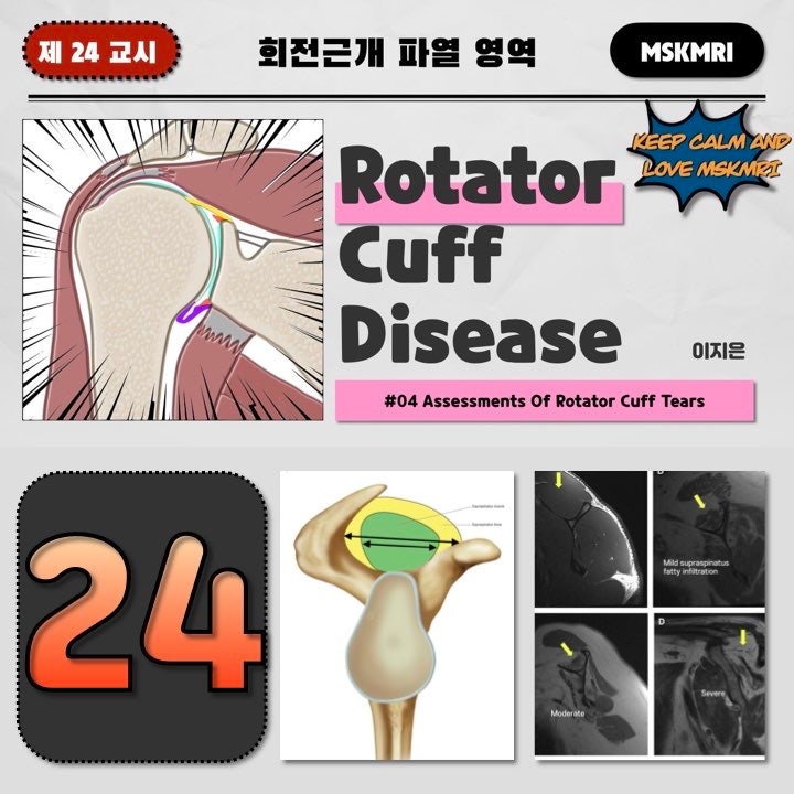  [Rotator cuff Tear 24] #04 Assessments of Rotator Cuff Tears
