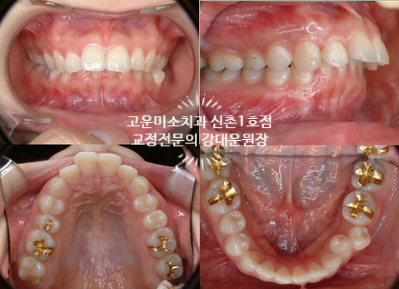  앞니돌출 윗니돌출 2급부정교합치료 고운미소치과 신촌1호점 증례