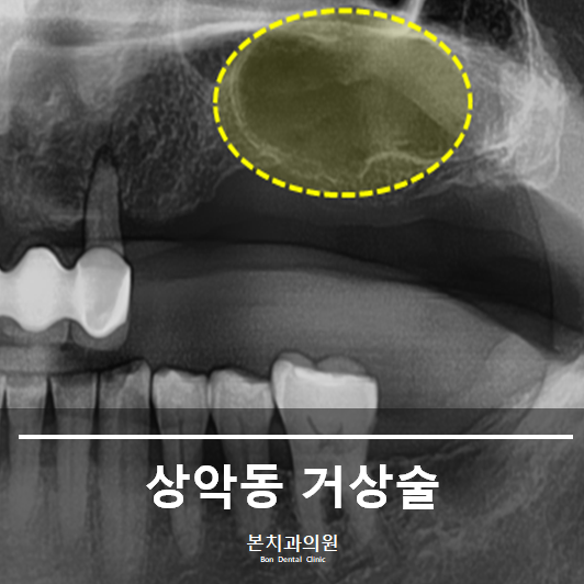 Multi-Sinus Dental 상악동 리프팅 치과를 선택하는 것이 왜 중요한가요? 6