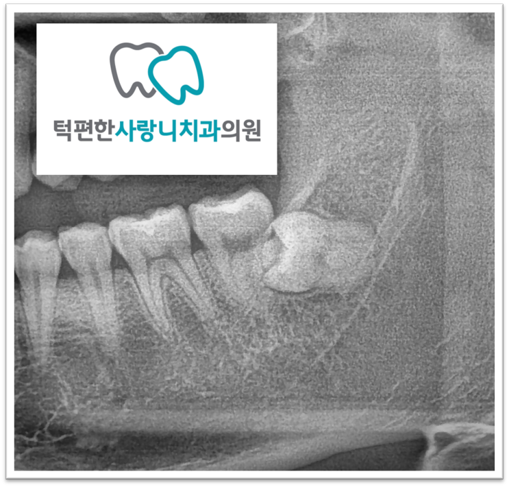  [범계역사랑니] 매복사랑니발치는 꼭 대학병원으로 가야할까?