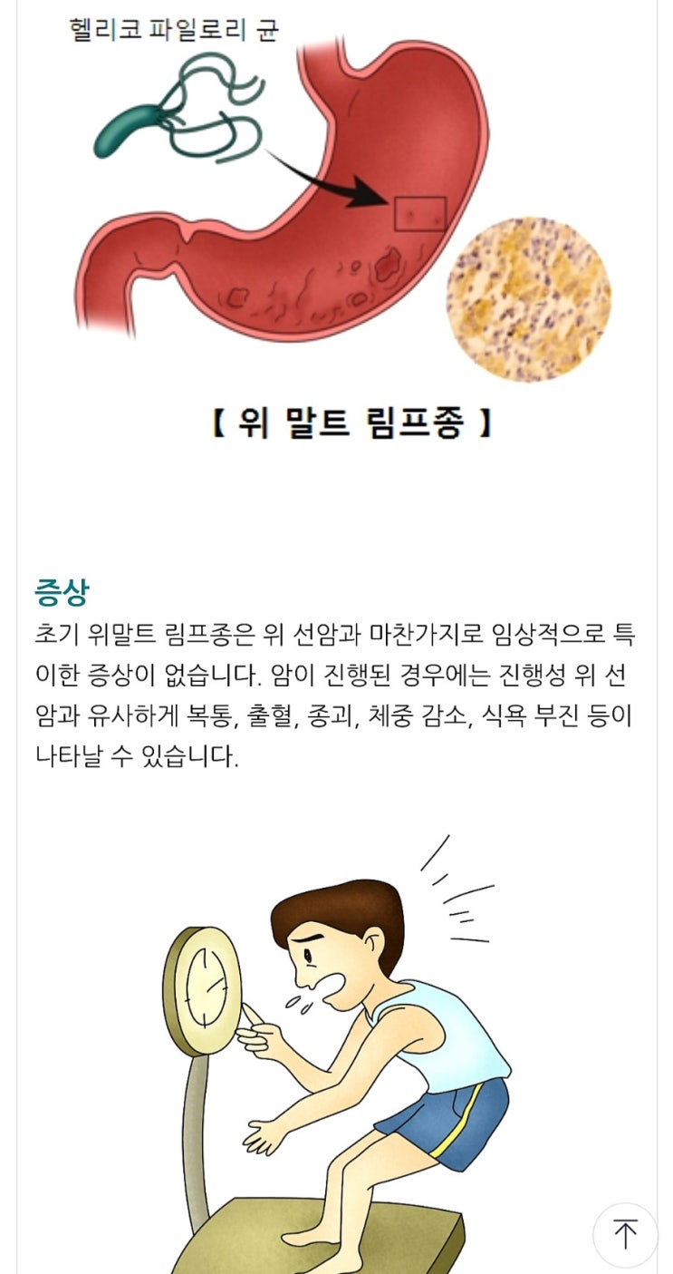  림프종 (B 세포 림프종.말토마)