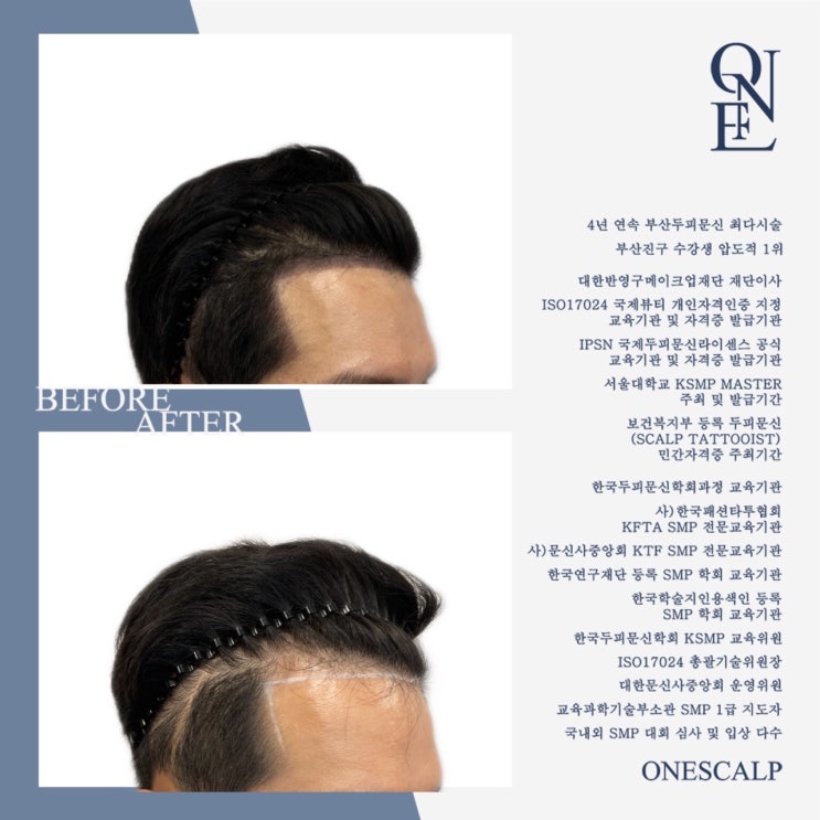 부산헤어라인 SMP두피문신 인증된교육기관 원스칼프에서!