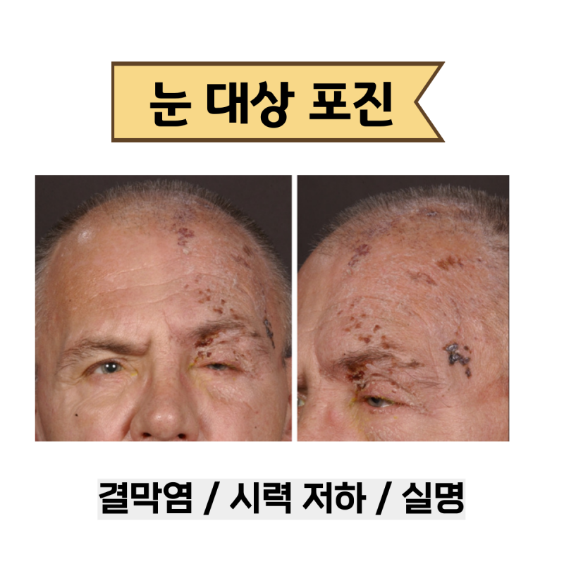 대상포진, 눈, 얼굴의 초기 증상 및 원인