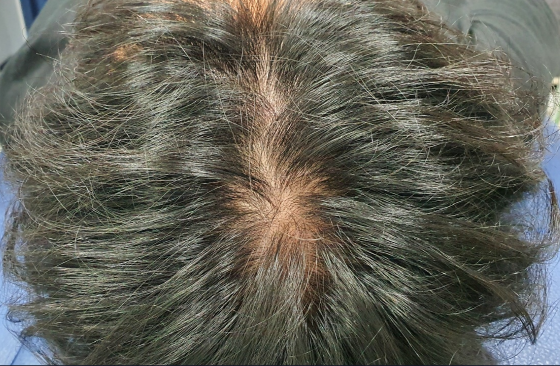 부모님과 함께하는 대구현풍탈모두피관리 부모님과 함께하는 대구현풍탈모두피관리