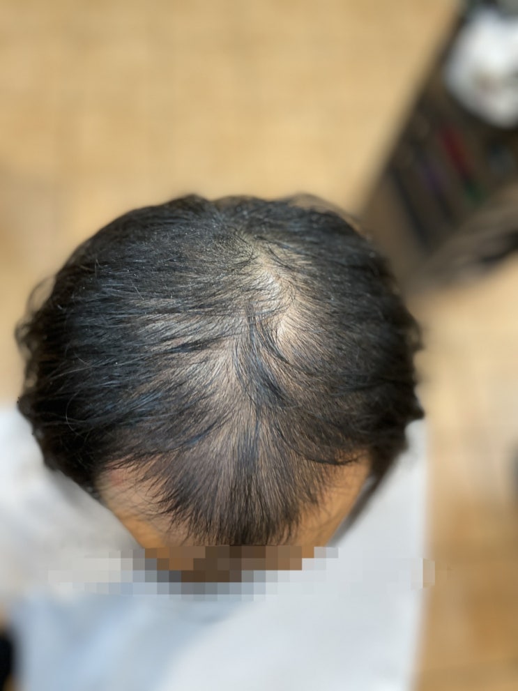  심한남자탈모 부산사상탈모전문 미용실 르네시떼헤어샵에 오시면 탈모펌으로 탈모와 이별준비하셔야됩니다!