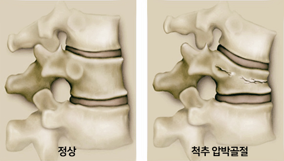  등과 허리 부위에 심한 통증이 느껴진다면? '척추압박골절' 의심