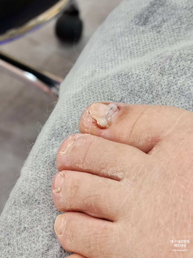 스트레스 해소를 위한 대구 자란 발톱 3