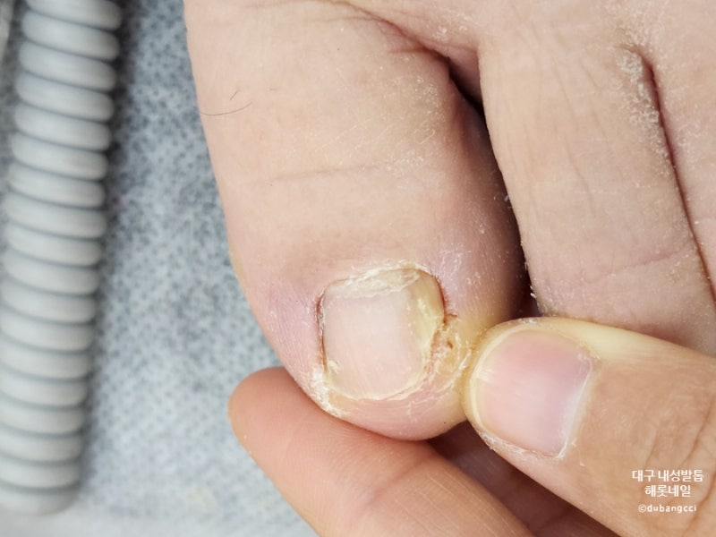 스트레스 해소를 위한 대구 자란 발톱 5