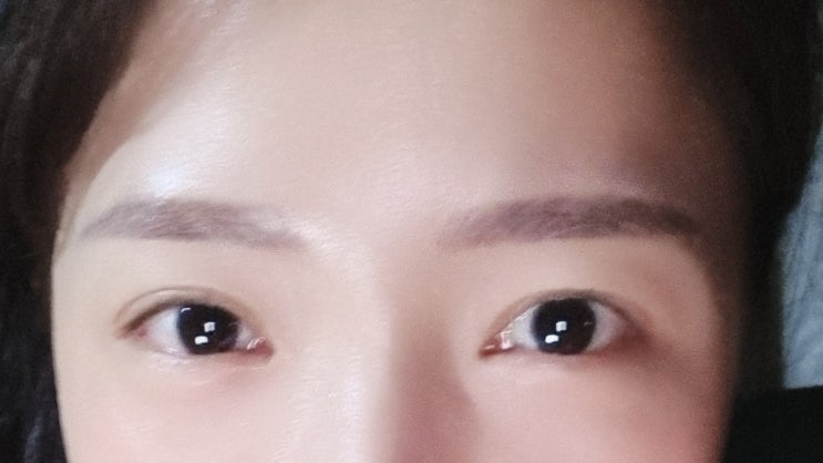  오래된 다래끼 수술 리얼후기"다시는 다래끼 째기 안할거야ㅠㅠ엉엉"