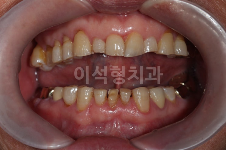 일원동 치과, 이석형치과 치아 균열증 Crack 의 진단 ,증상, 치료