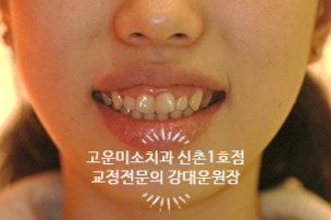  거미스마일 잇몸많이 보이는 치료증례 파트2   신촌치과 고운미소신촌1호점 증례