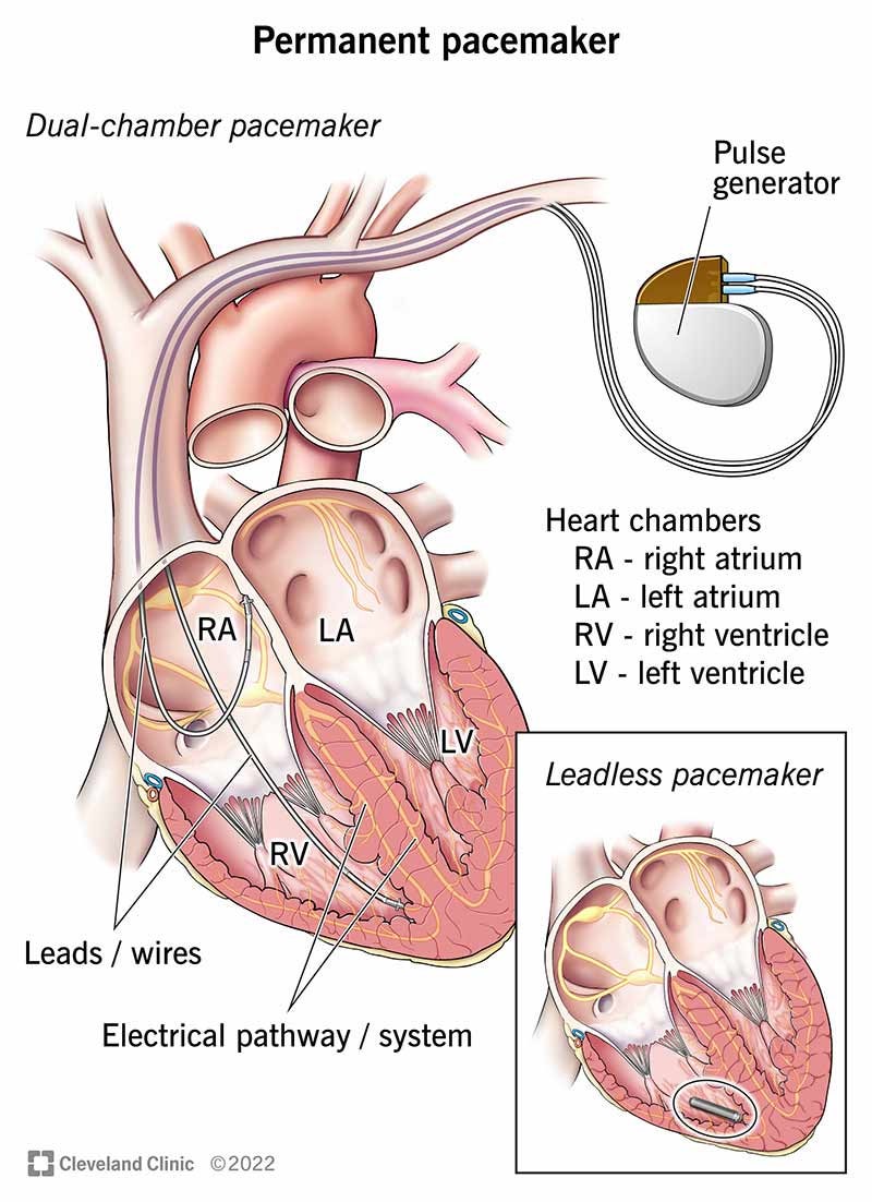 인공심박동기 pacemaker AAI, VVI, VDD, DDD : 네이버 블로그