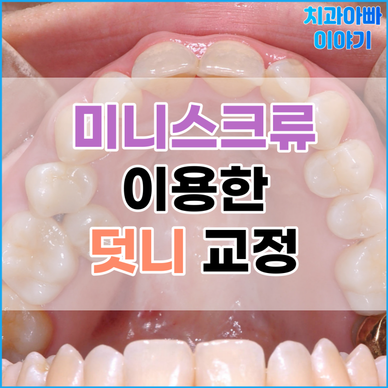 덧니교정 발치를 진행한 케이스