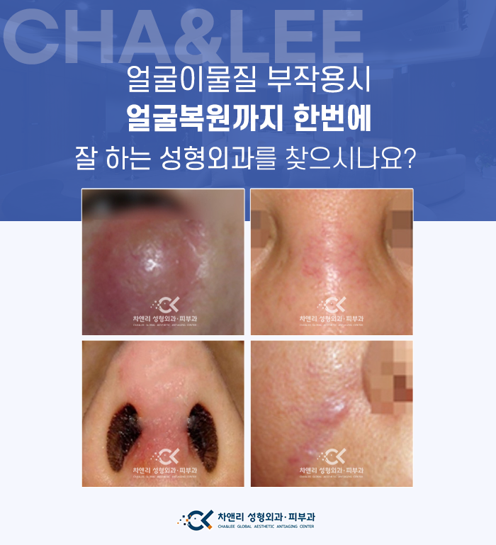  얼굴이물질제거 수술과 복원까지 한번에!