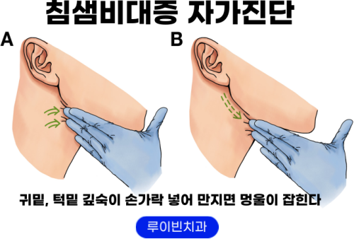 귀밑 멍울, 턱밑 멍울, 침샘 염증, 증상, 원인, 치료, 병원