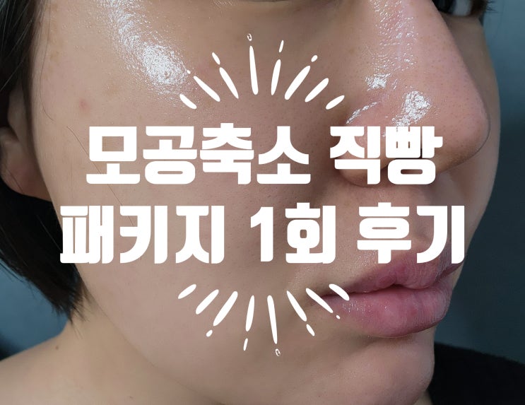  넓어진 나비존모공 때문에 모공축소시술 엑셀브이 2주차
