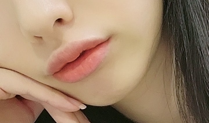  [대구 성형외과] 입술필러, 입꼬리 보톡스 내돈내산 후기