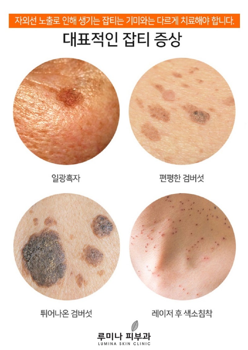 얼굴잡티제거 기미,검버섯까지 한번에 5