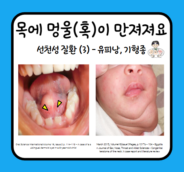  목에서 멍울이 만져져요 (4) - 선천성 경부 종물(Neck mass)과 양성종양 (3) : 유피낭(Dermoid cyst), 기형종(Teratoma)