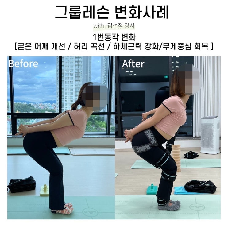  [대구SNPE] 강직성 척추염으로 고생하시다가 SNPE로 통증 잡으신 회원님 후기