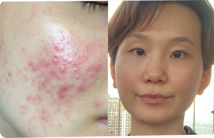  여드름 토너 인생템 발견으로 여드름 졸업했어요!