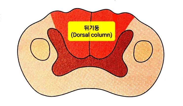 척수매독(Tabes dorsalis) - 매독균(Syphilis)에 의한 등쪽섬유기둥(Dorsal column) 병변