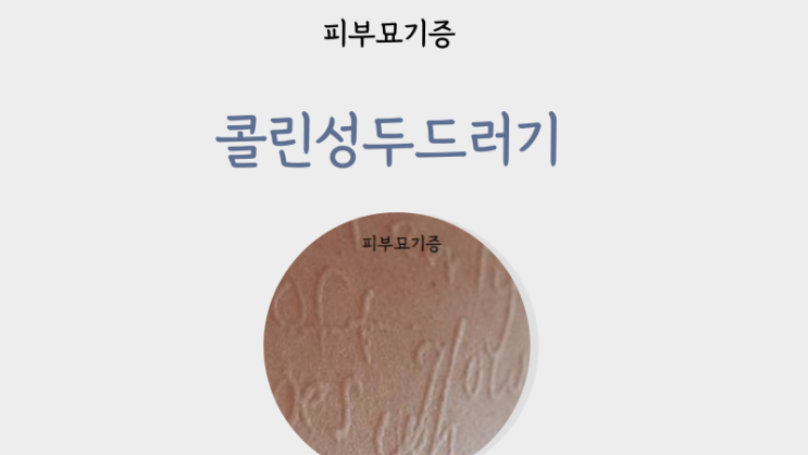  콜린성두드러기 피부묘기증 원인 피부두드러기 검사방법