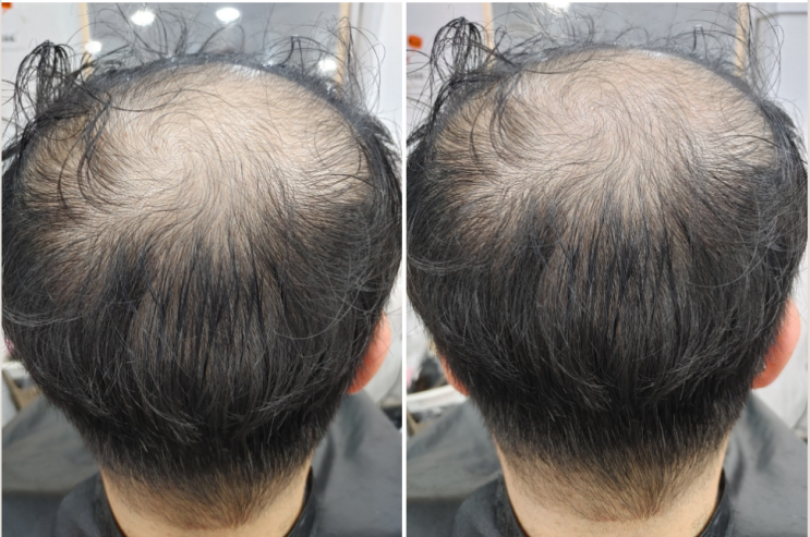  가발이 고민중이신데 가격이 부담되시나요
