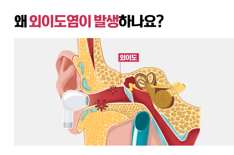 이어폰, 오래 착용 시 중이염까지? 3