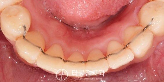 교정 유지장치 떨어짐, 방치하면 발생하는 일 : 네이버 블로그 교정 유지장치 떨어짐, 방치하면 발생하는 일 : 네이버 블로그