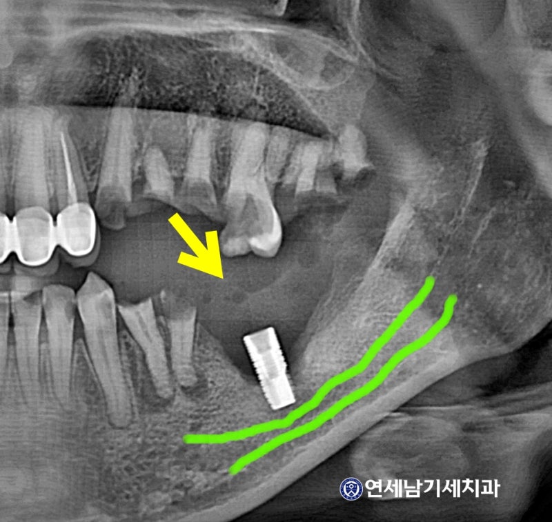 발치후 임플란트 늦어 치아정출, 강동구임플란트 5