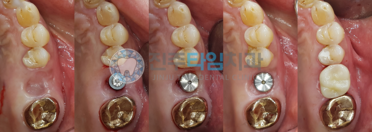  치아뿌리 끝 염증, 발치후 임플란트 #에스락임플란트 #SLOCK