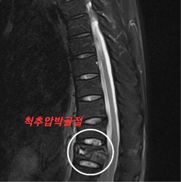 손실없는 척추 압박 골절 상해 보상 계약 7