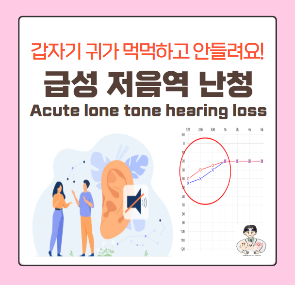 급성 저음역 난청(Acute low tone hearing loss) - 갑자기 귀가 먹먹하고 안들려요!