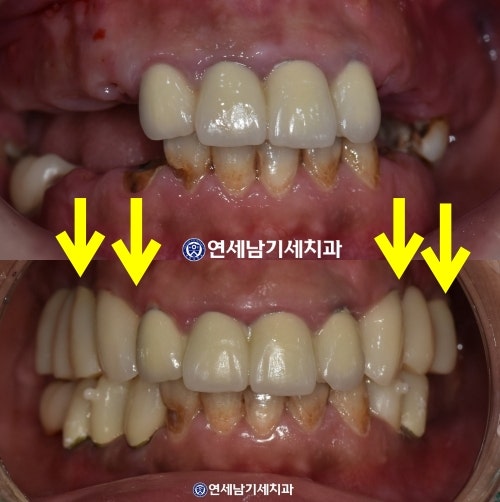 발치후 임플란트 늦어 치아정출, 강동구임플란트 2