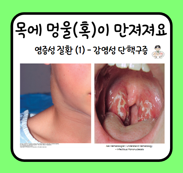  목에서 멍울이 만져져요 (5) - 경부 종물(Neck mass)의 염증성 질환 (1) : 감염성 단핵구증(Infectious mononucleosis)