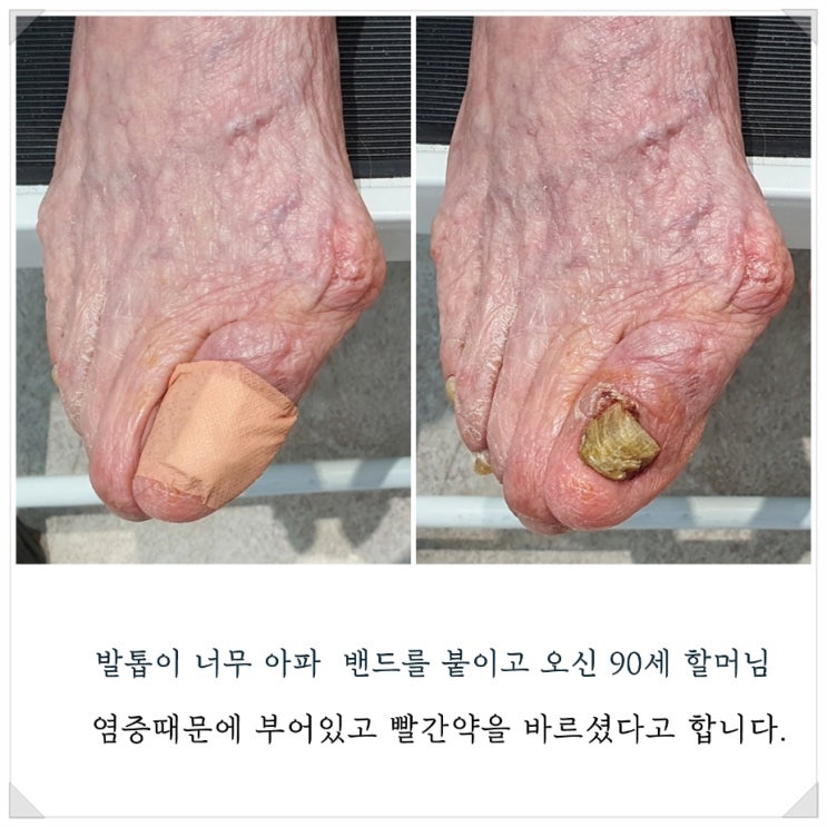 90세 할머니의 역대급 육아종 염증발톱 관리후기/성남수원수지보정동백죽전동/주네일푸스케어용인수지점/무좀발톱염증파고드는내향성발톱손톱변형전문점 90세 할머니의 역대급 육아종 염증발톱 관리후기/성남수원수지보정동백죽전동/주네일푸스케어용인수지점/무좀발톱염증파고드는내향성발톱손톱변형전문점